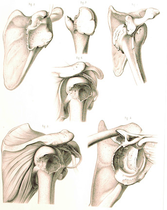 Bonhams MALGAIGNE, JOSEPH. 18061865. Traité des fractures et des